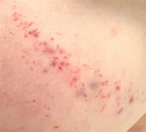 Strange rash like love bite on breast.